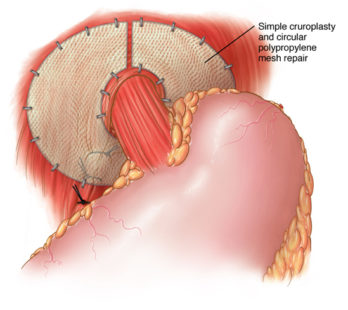 Laparoscopic Repair Of Hiatal Hernia