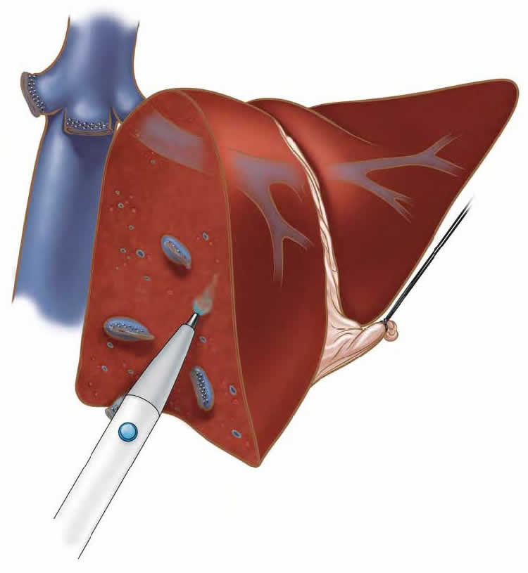 laparoscopic-liver-biopsy-hepatectomy-b