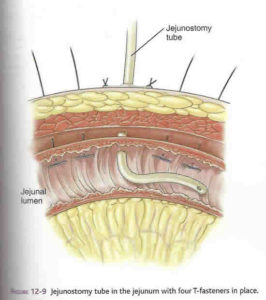 Laparoscopic Gastrostomy2